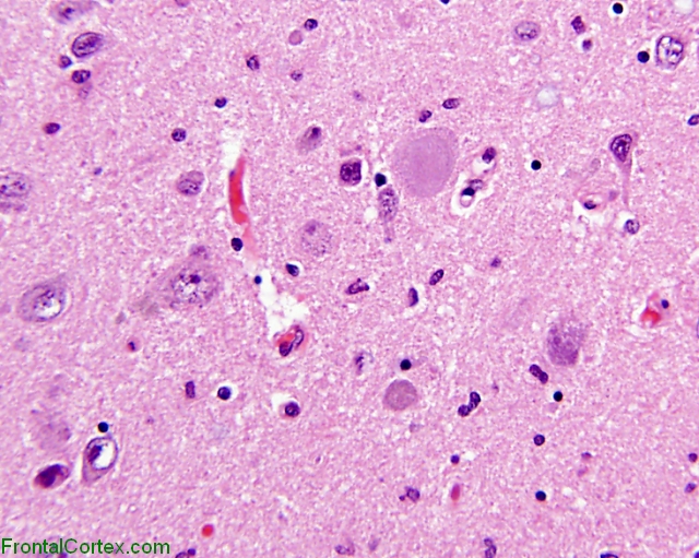 Subthalamic NFT in PSP